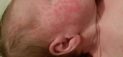 Что вы ели на ГВ при аллергии у малышей?