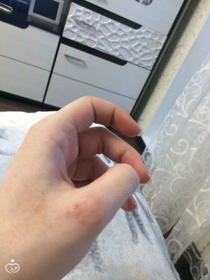 Аллергия?