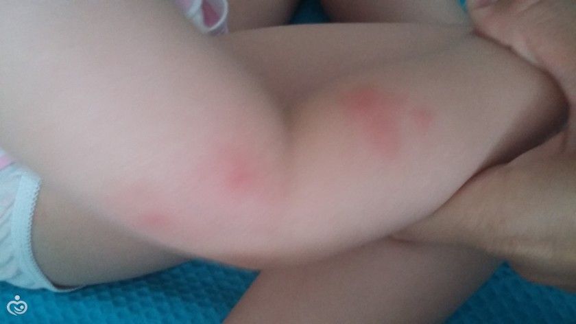 отдых в Греции. пятна у ребенка. sos! :( отдых в Греции. пятна у ребенка. sos! :(